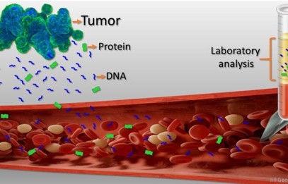Rethinking Cancer: Could Microbial DNA in Your Blood Be a Sign of Cancer?