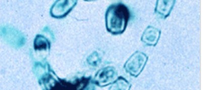 Researchers in US and Israel Detect Fungal DNA in Most Cancer Types Found in the Human Body