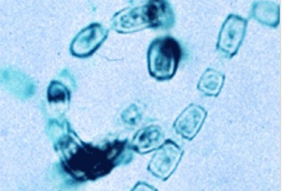 Researchers in US and Israel Detect Fungal DNA in Most Cancer Types Found in the Human Body